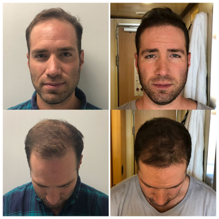 Follicular Unit Extraction (FUE) Hair Transplants | Chicago