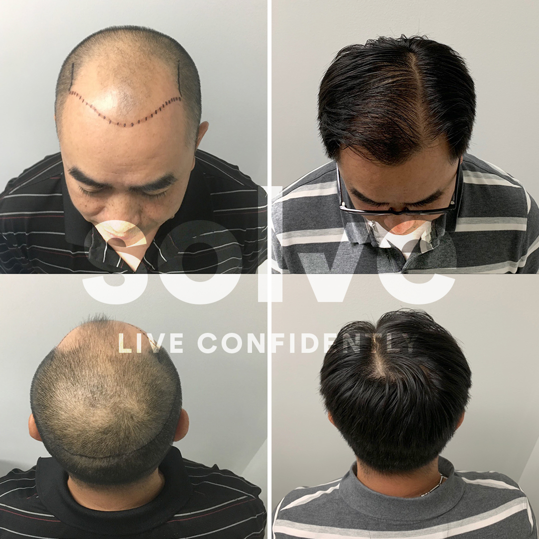 Industry Leading Hair Loss Results | Solve Clinics | Chicago